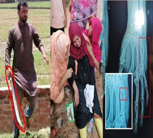 মায়ের হাতের কবজি ভেঙে ঝলসে দিল মেয়ের হাত